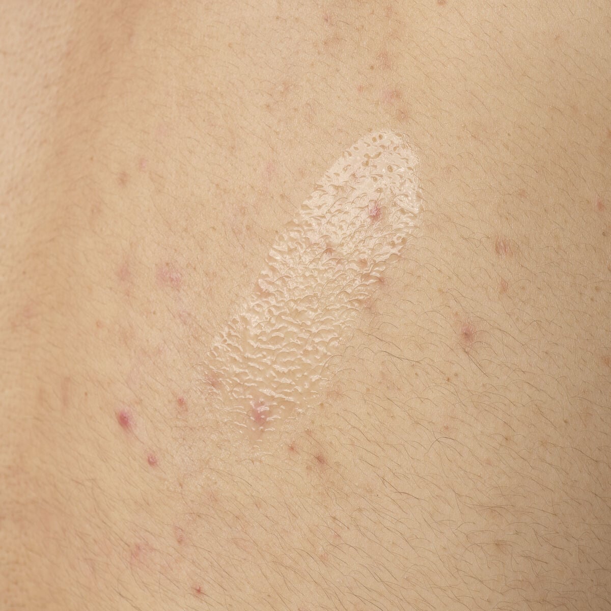 salicylic-acid-0-5-body-serum-i2 ORD-salicylic-acid-05-body-240ml-application.jpg