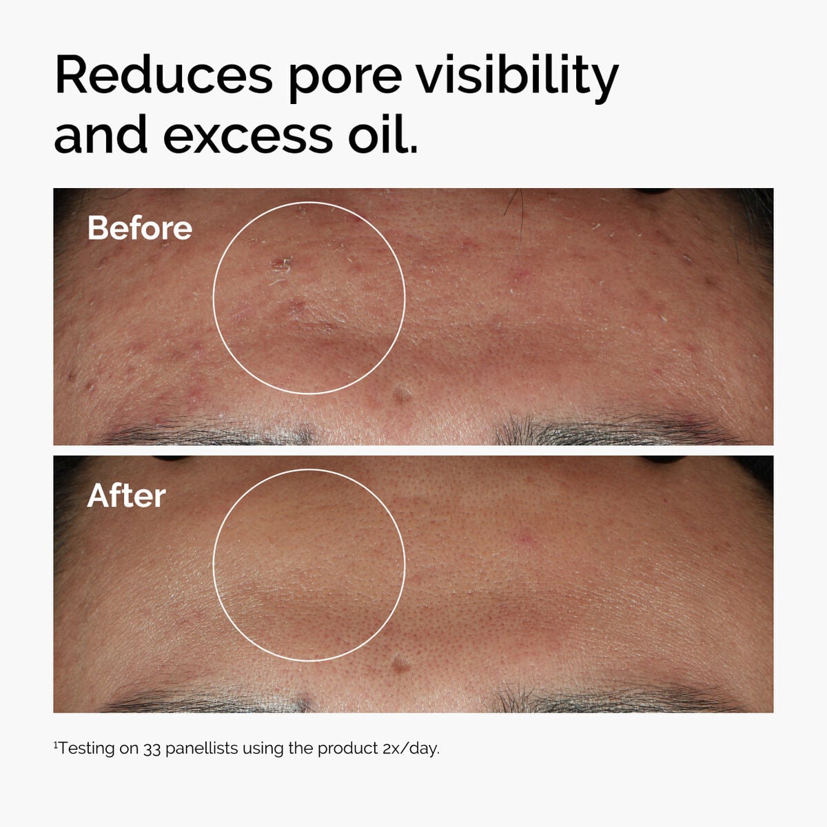 niacinamide-10-zinc-1-z2 ord-niacinamide-zinc-blemish-serum-before-after-pores.jpg