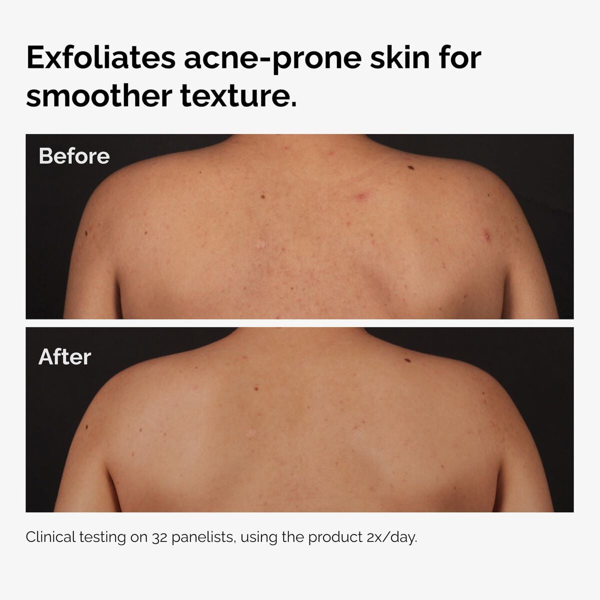 salicylic-acid-0-5-body-serum-i2 ord-salicylic-acid-body-serum-before-after-graphic-NA.jpg